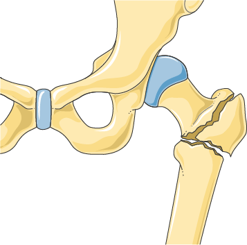 Anatomical illustration of the hip from the front, showing a break running through the upper end of the thigh bone just below the ball of the hip joint
