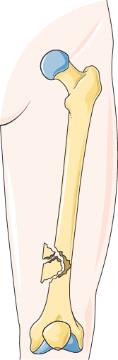 Anatomical illustration of a long bone broken into several separate fragments, a comminuted fracture