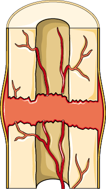 Anatomical illustration of a cross section through a healing bone fracture, showing new bone forming between the bone ends