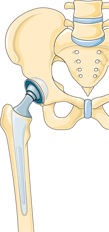 Anatomical illustration of a hip replacement, showing a stem fixed inside the thigh bone with a rounded head sitting in a cup implanted in the socket of the pelvis
