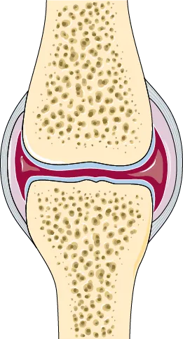 Anatomical illustration of a healthy joint in cross section, with an even layer of cartilage covering both bone ends and an even space between them
