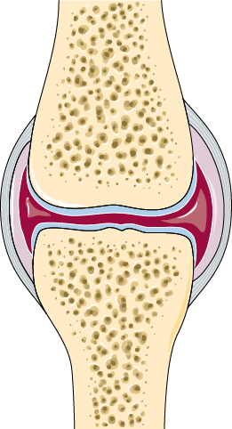 Cross section of a healthy joint, showing a smooth layer of cartilage on each bone end and an even space between the bones