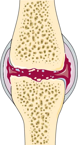 Anatomical illustration of a joint affected by osteoarthritis in cross section, with the cartilage thinned and broken up and the space between the bone ends narrowed and uneven