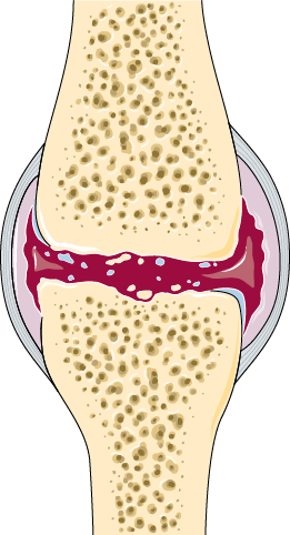 Cross section of a joint affected by osteoarthritis, showing broken and thinned cartilage, a narrowed space between the bones and irregular bone surfaces