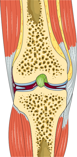 Anatomical illustration of the knee from the front, cut through to show the end of the thigh bone, the top of the shin bone, the cartilage surfaces between them, the meniscus and the surrounding muscles and ligaments