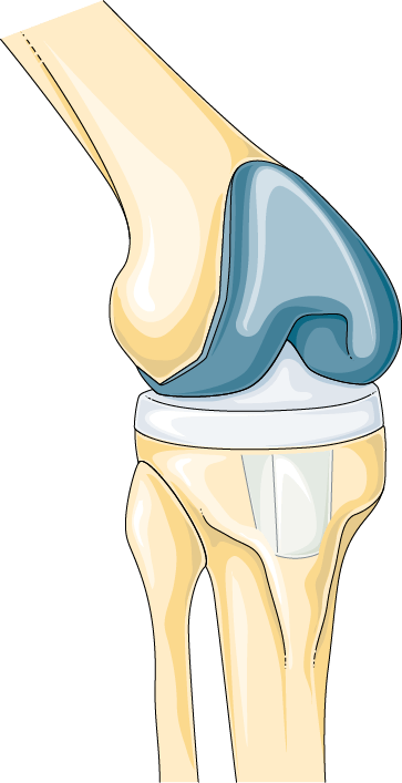 Anatomical illustration of a total knee replacement in place: a metal component capping the end of the thigh bone, a component on the top of the shin bone, and a bearing between the two